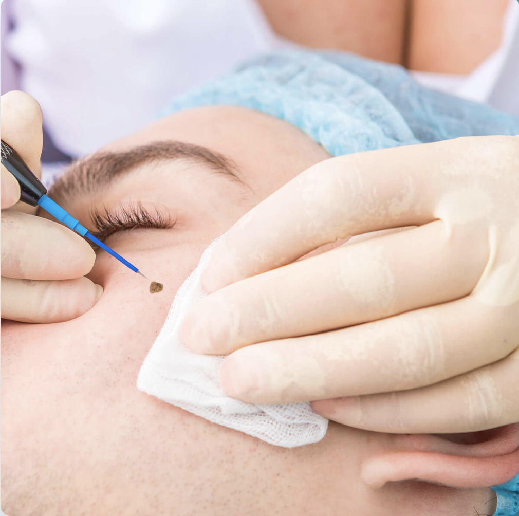 Il Quadrilatero diatermocoagulazione