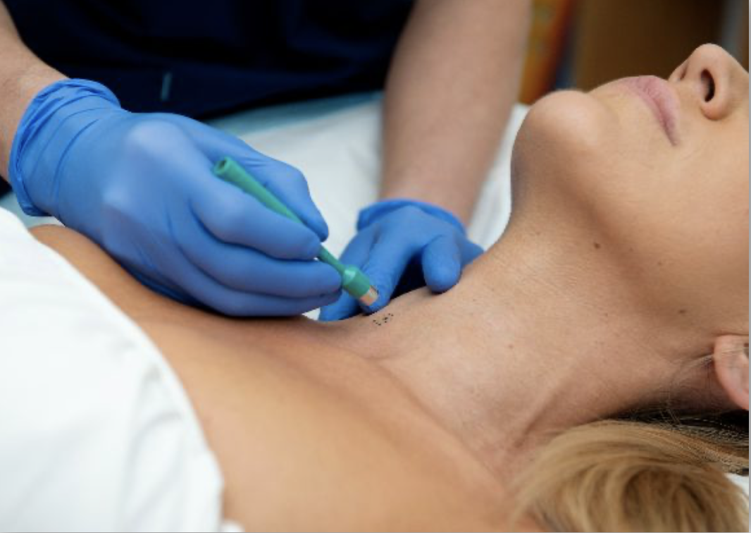 Il Quadrilatero Biopsia cutanea