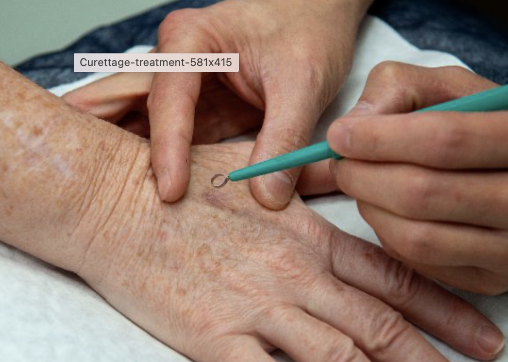 Il Quadrilatero courettage