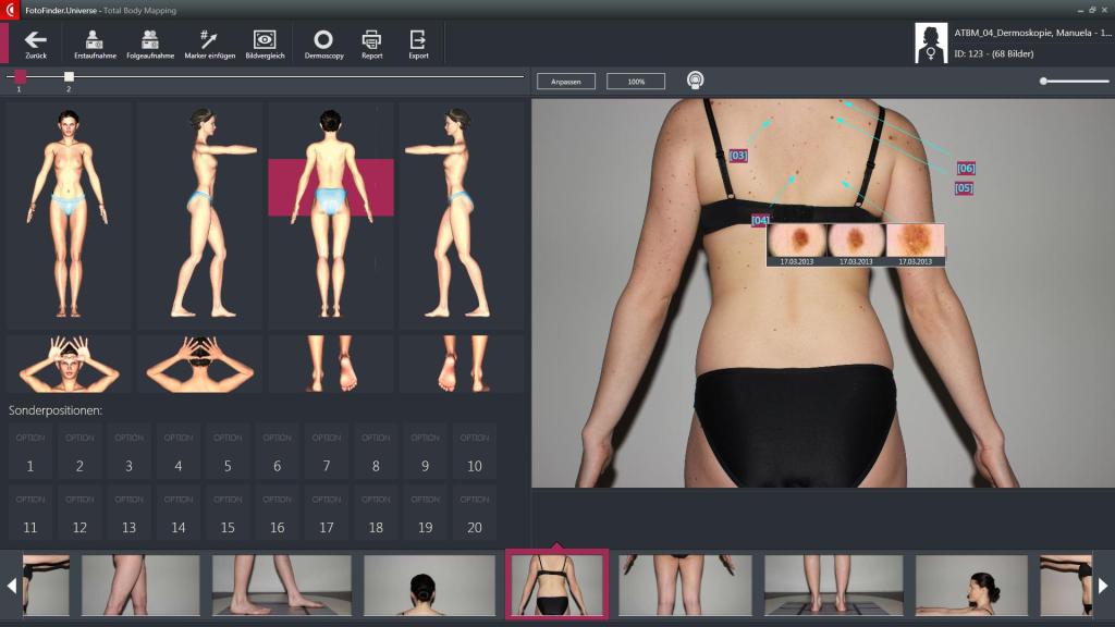 Totalbody Photography - Il sistema di mappatura dei nei a Genova e Liguria