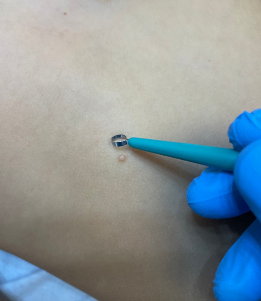 Courettage di mollusco contagioso