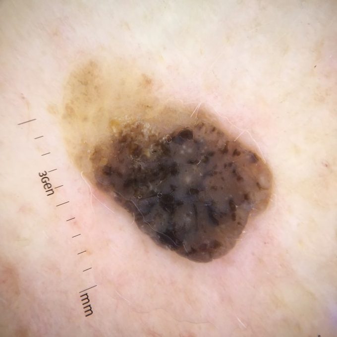 Cheratosi seborroica