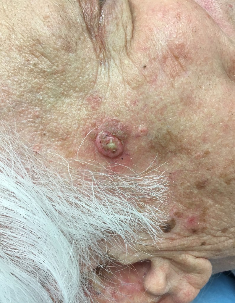 Carcinoma  spinocellulare - Cos'è il carcinoma spinocellulare cutaneo?