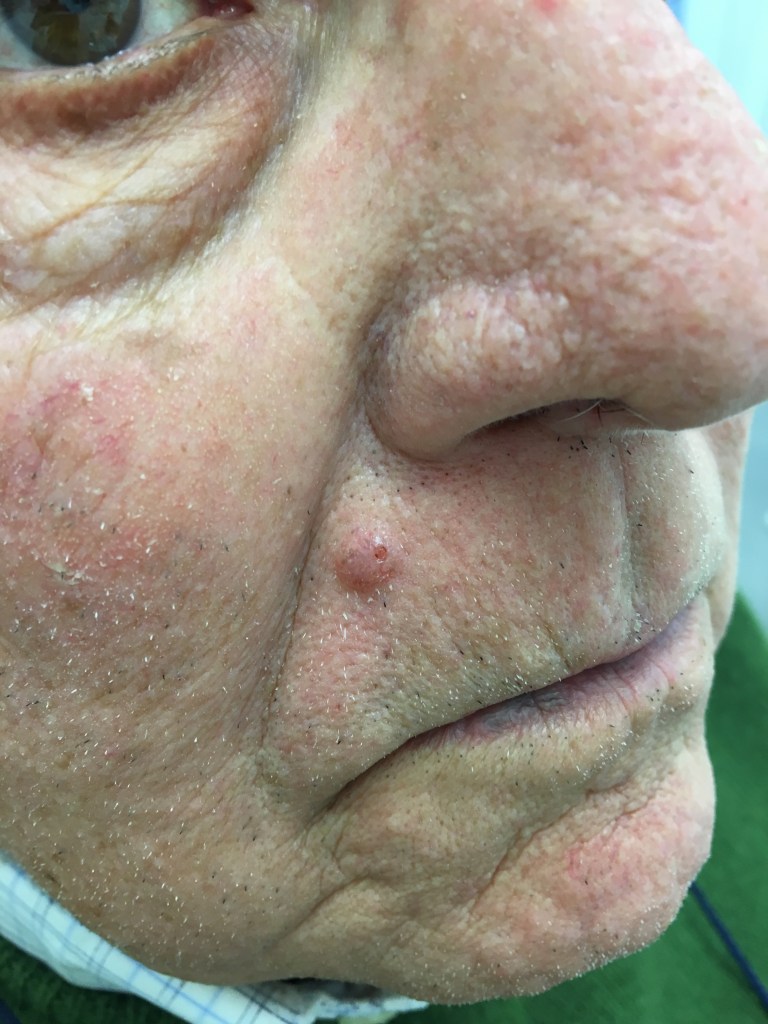 Carcinoma basocellulare