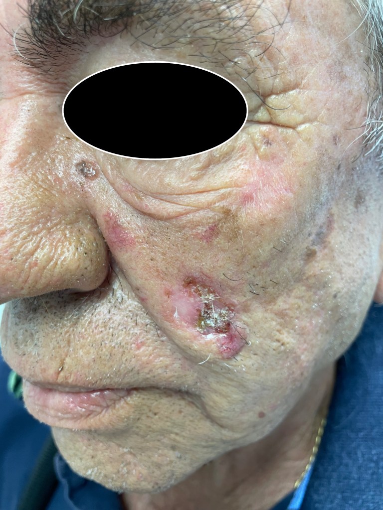 Carcinoma basocellulare