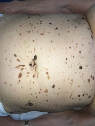 Cheratosi seborroica