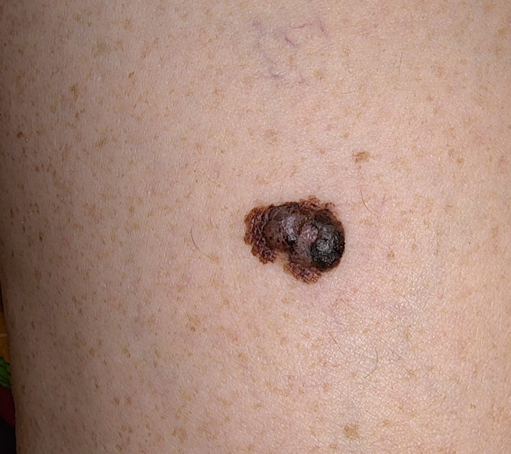 Melanoma