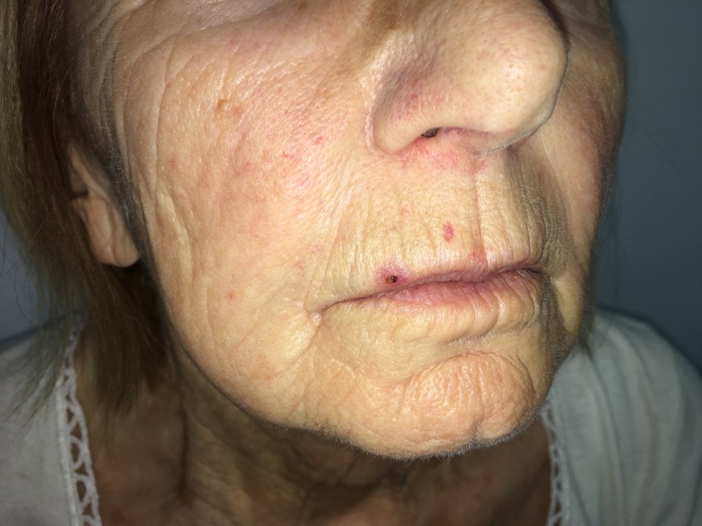 Carcinoma spinocellulare