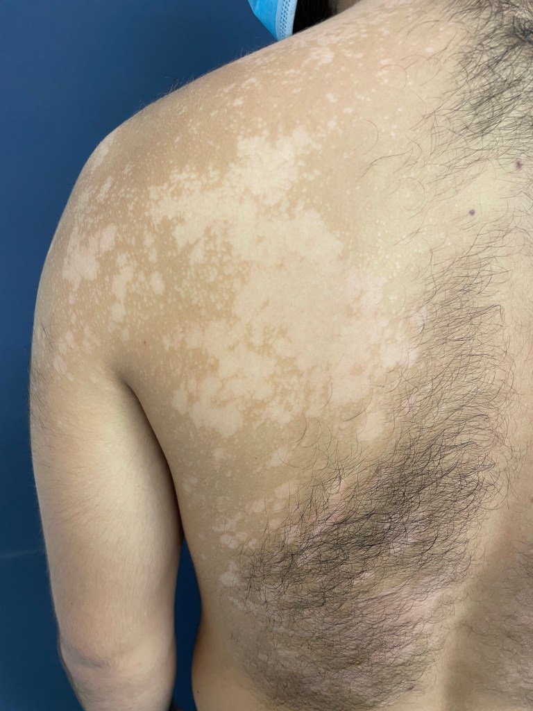 Pitiriasi versicolor